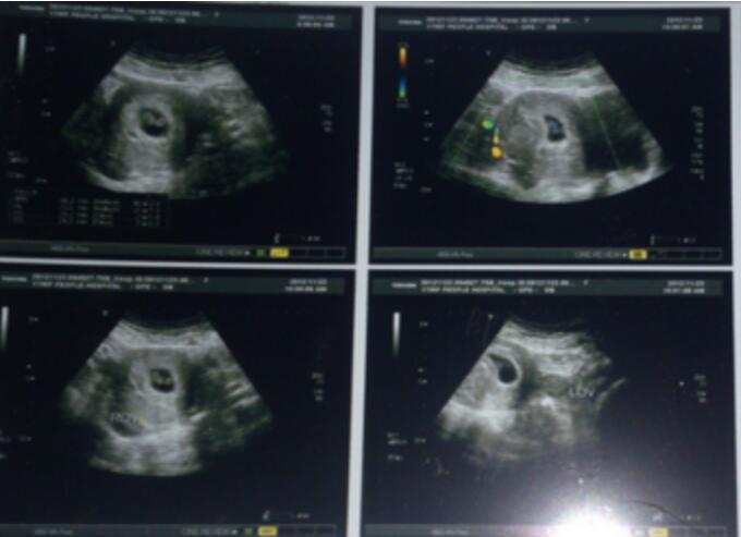 从唐氏筛查、B超、四维彩超可判定胎儿性别,