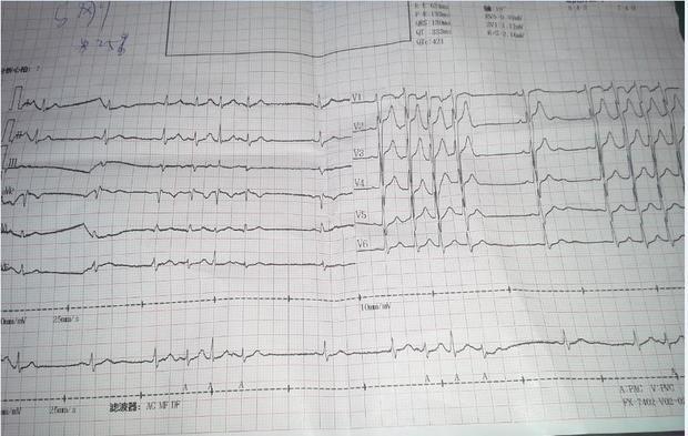 我体检时发现 心电图不正常,医生说是连续室上性期前收缩 不知道这病
