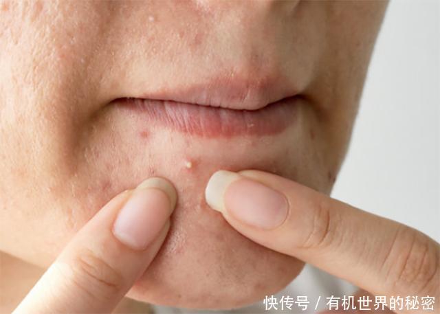 脸上长痘因为螨虫?3个信号别忽视,用1方法洗很