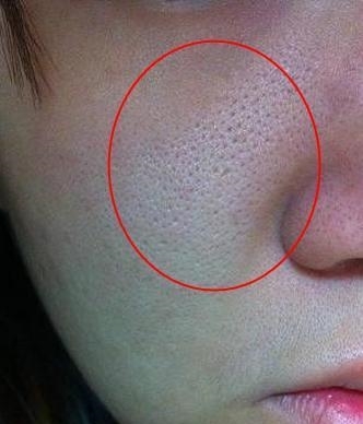 脸上有螨虫不要担心, 每天抹点它轻松除螨, 可惜