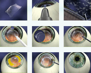 有晶体眼人工晶体,又称可植入式接触镜),icl的植入位置是眼后房,虹膜