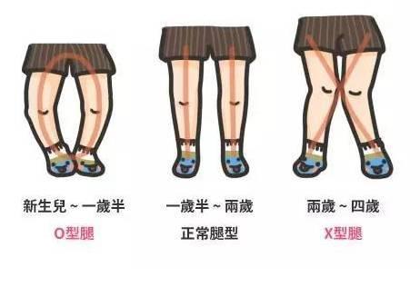 宝宝的X或O型腿到底正不正常?需不需要补钙?