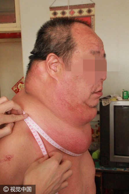 【转】北京时间 53岁男子得怪病 脖子周长97厘米起床困难易摔倒 - 妙康居士 - 妙康居士~晴樵雪读的博客 【转】北京时间 53岁男子得怪病 脖子周长97厘米起床困难易摔倒 - 妙康居士 - 妙康居士~晴樵雪读的博客