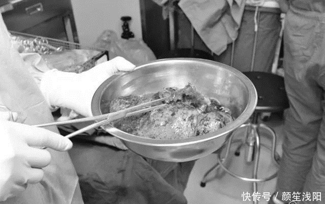 黑龙江省内首例双肺移植|哈医大二院出动百余