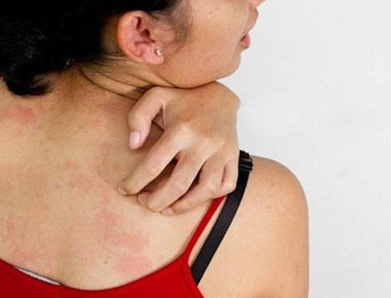 湿疹性皮炎瘙痒怎么办?这里有摆脱痛苦的良方_【今日爆点】