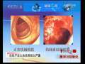 健康之路 腹泻与结肠炎