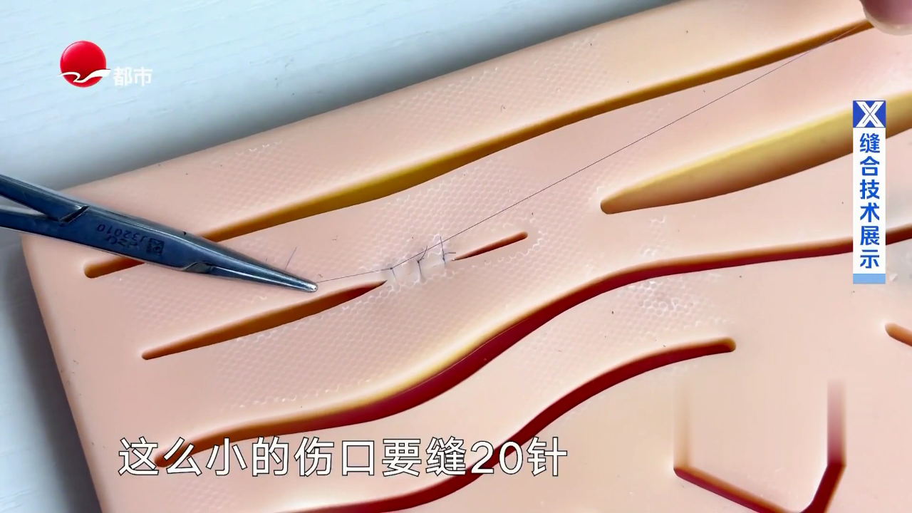 X诊所. 疤痕干预的黄金时间