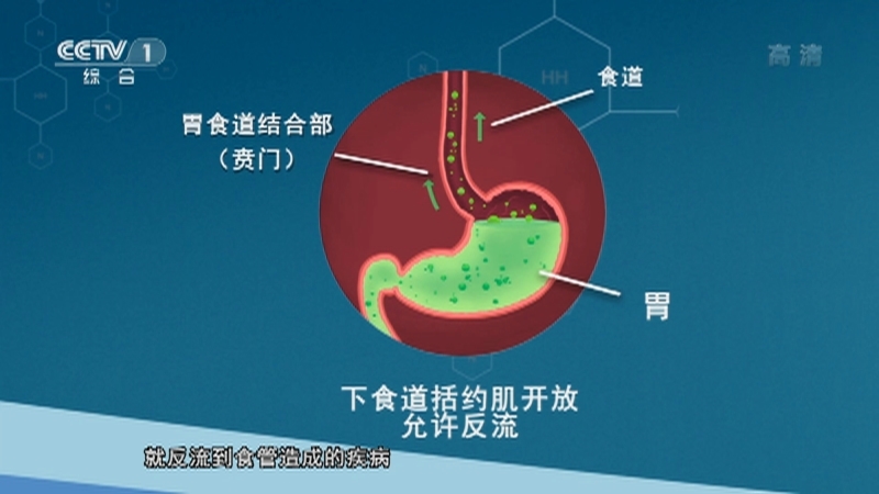 《人口》 20210818 科学预防胃食管反流病
