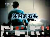 健康之路 胆结石之惑