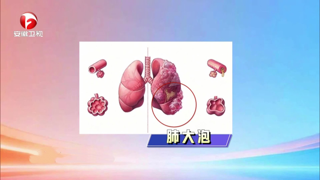 健康大问诊 沉默的“呼吸杀手”——慢阻肺
