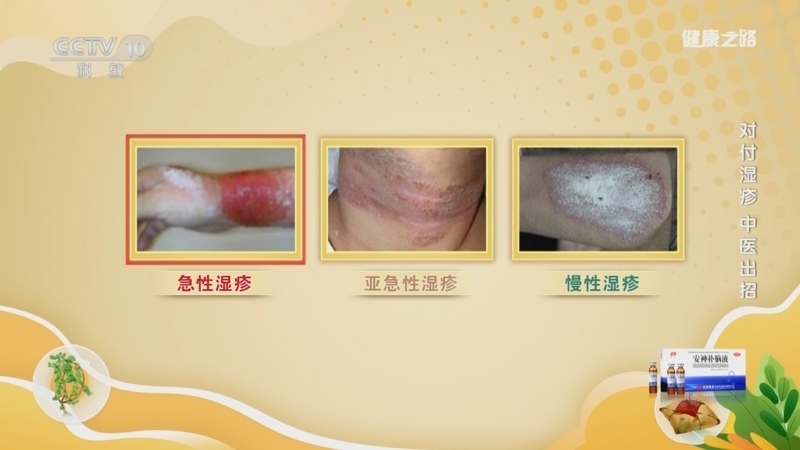 《健康之路》 20251014 对付湿疹 中医出招
