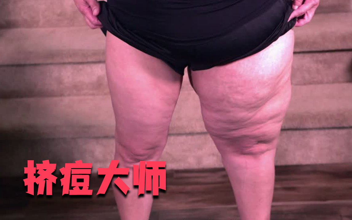 挤痘大师 持续存在的囊肿