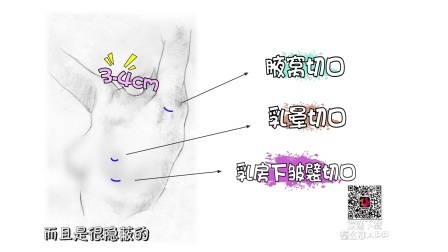 假体隆胸原来是这样，硅胶假体安全性高成首选，太平公主变性感尤物不是梦