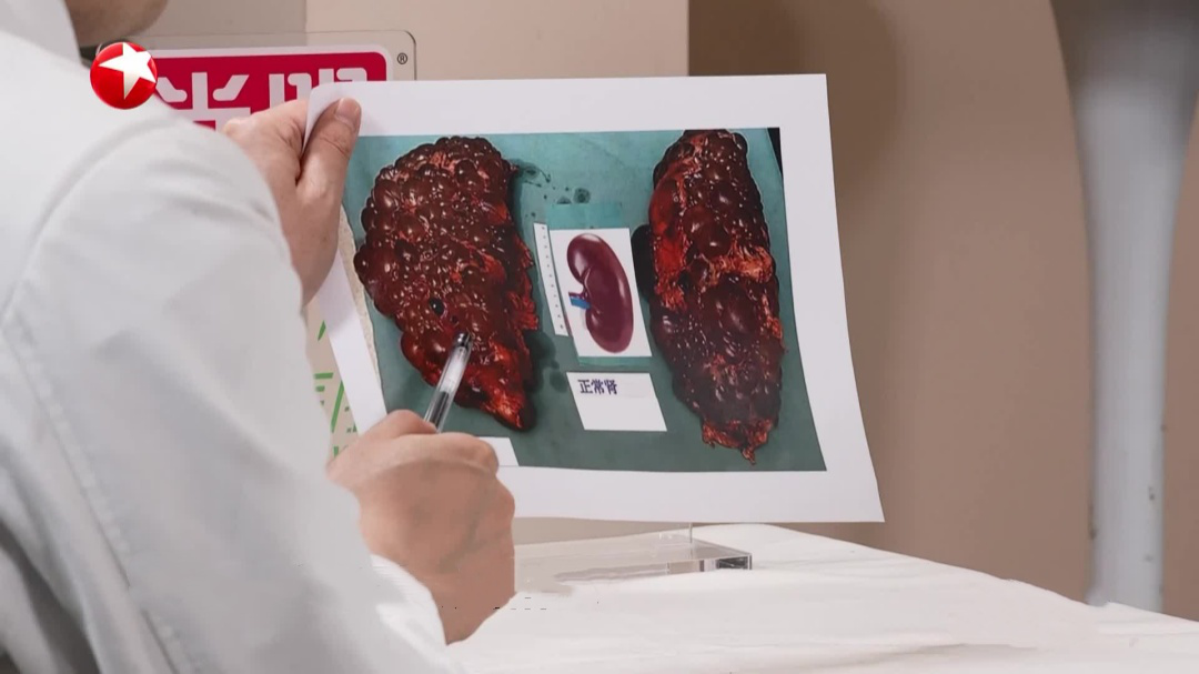 快闪医院——多囊肾病一定会遗传给家人吗