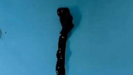 老人突然无法行走，医生取出40厘米异物！