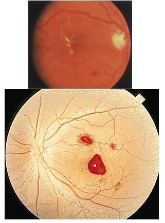 糖尿病眼底出血看不清了还能治好吗