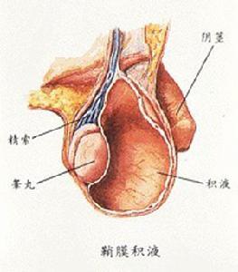 小兒睪丸鞘膜積液