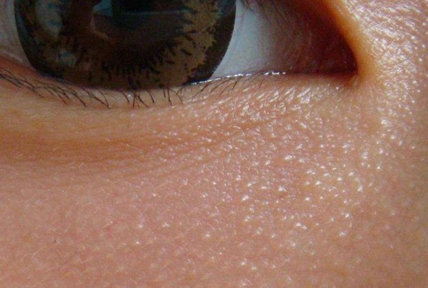 补充:请问这是粟丘疹还是什么,有除手术外的治疗吗?